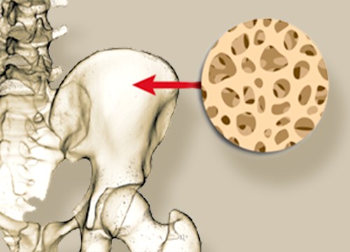 Bone-marrow-derived SVF