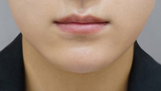 Lip filler — clinic photo