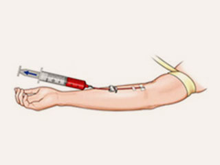 1. Blood or fat harvest